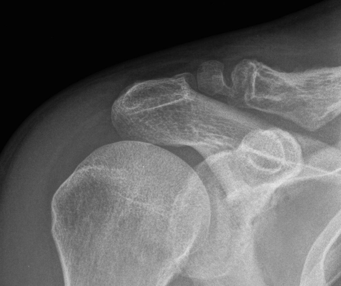 Distal Clavicle Nonunion 